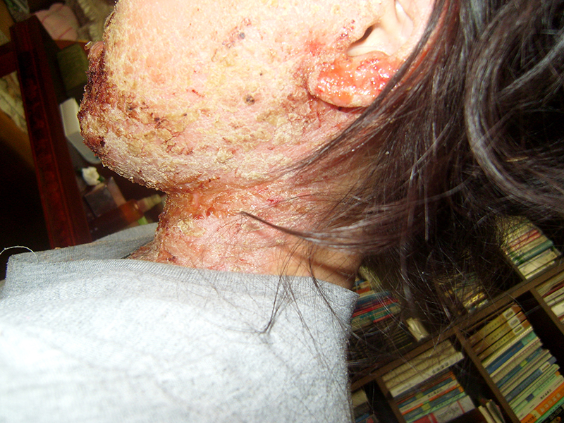 사진처럼 피부가 뒤집어지는 이유는 아토나 관리로 몸 안에 있던 독소가 빠져나오면서 생기는 현상입니다. 과거에 스테로O드를 많이 사용한 사람에게만 이런 반응이 나타나요.